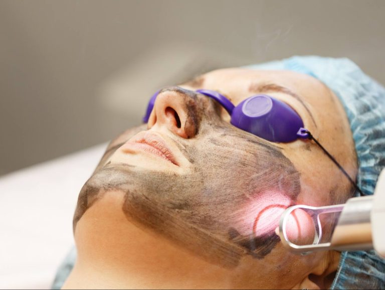 Hollywood-Carbon-Peel_BG