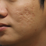 Micro-needling-x-Alpha-peel-benefits-1