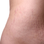 Micro-needling-x-Alpha-peel-benefits-3