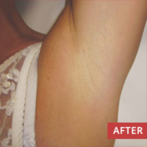 Underarm After