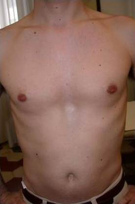 Chest After