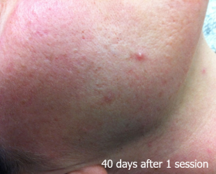 LaserHR_Face_B&A_02_40dayslater_1session