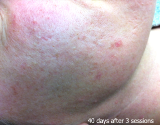 LaserHR_Face_B&A_03_3sessions