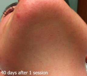 LaserHR_Face_B&A_2_40dayslater_1session