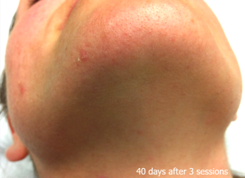 LaserHR_Face_B&A_3_3sessions