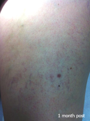 Vascular_B&A_0002_1mth post