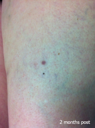 Vascular_B&A_0003_2mth post