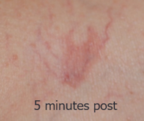 Vascular_B&A_10_5mins post